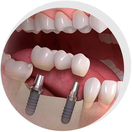 Seiker Zahnärzte Celle - Leistungen: Implantologie