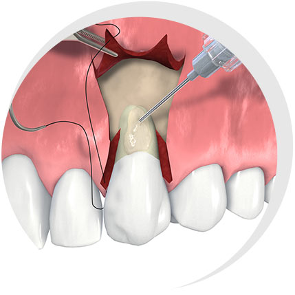 Seiker Zahnärzte Celle - Leistungen: Zahnärztliche Chirurgie